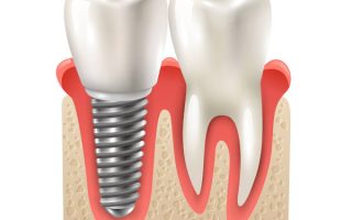 implante-dentario-tomografia-celular-600x500-1